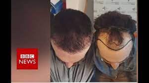 Hair Loss Fighting Against My Receding Hairline Bbc News Youtube