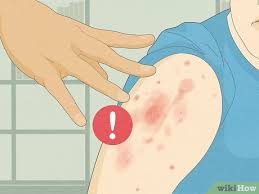 Image result for scabies on humans