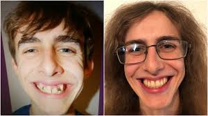 We did not find results for: Teeth Shifted After Braces Reddit Teethwalls