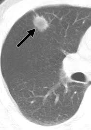 However, ct scanning of the chest is often needed because of the lack of sensitivity of the chest radiographs in detecting mediastinal lymph node positron emission tomography (pet) scanning is a new imaging modality whose role in the assessment of lung cancer is still being determined. T1 Non Small Cell Lung Cancer Imaging And Histopathologic Findings And Their Prognostic Implications Radiographics