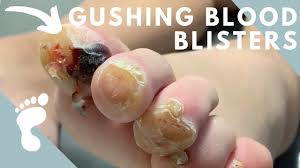 Connect with certified doctors online, 24 hours a day. Nasty Festering Blood Blisters Youtube