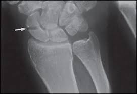 Diagnosis And Management Of Scaphoid Fractures American Family Physician 1,443 отметок «нравится», 41 комментариев — medical doctor (@doctordconline) в instagram: of scaphoid fractures