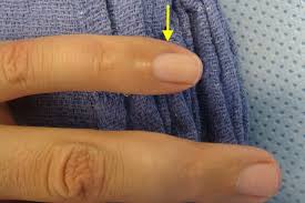 Image result for Glomus tumor