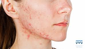 Acne Un Problema Que Se Sigue Padeciendo Hasta Los 45 Anos