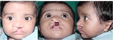 UNILATERAL COMPLETE CLEFT LIP REPAIR: A MODERN MORPHO-FUNCTIONAL SURGICAL  APPROACH