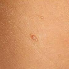 Il se présente sous forme de petites excroissances blanches ou de la couleur de la peau, de quelques millimètres de diamètre, groupées sur le visage. Dartre Cause Contagieux Traitement Enlever Les Plaques