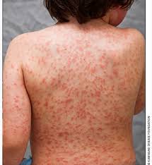 Scans also showed inflammation in the lungs, gallbladder and colon. Clinical Practice Guidelines Kawasaki Disease