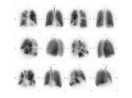 Plicní hypertenze (plicní arteriální hypertenze) je zvýšení tlaku v systému plicních tepen, což může být způsobeno zvýšením rezistence v krevním řečišti plic nebo významným zvýšením průtoku krve v. Informace Pro Lekare Plicni Hypertenze