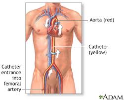 Posted by anonymous on feb 03, 2014. Coronary Artery Balloon Angioplasty Series Procedure Part 1 Medlineplus Medical Encyclopedia