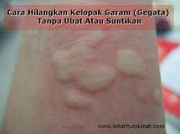 Savesave petua hilangkan gatal01 for later. Cara Hilangkan Kelopak Garam Gegata Tanpa Ubat Atau Suntikan Pengedar Shaklee Kota Damansara Pj