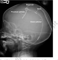 Imaging Of Ventricular Shunts Semantic Scholar