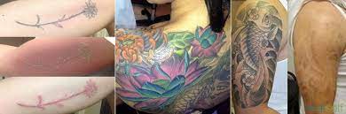 Lasers are the most common method of tattoo removal performed today. 10 Things I Wish I Knew Before Laser Tattoo Removal Tattoo