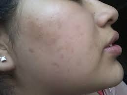 Acne scars before and after reddit. Acne Any Tips To Get Rid Of Acne Scarring Skincareaddiction
