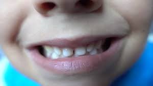 Check spelling or type a new query. Fore Tooth Stock Video Footage 4k And Hd Video Clips Shutterstock