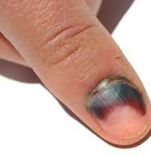 To treat nail mold you will need products that have anti bacterial and anti fungal properties… …to ensure you treat either a bacteria or fungus infection because many people mistaken greenies, a bacteria as a fungus. Subungual Hematoma Symptoms Causes And Treatment