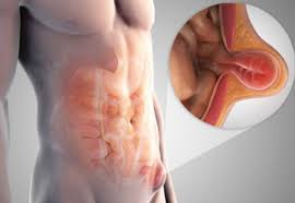Pin On Hernia