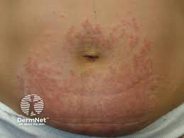 Image result for pruritic urticarial papules and plaques of pregnancy