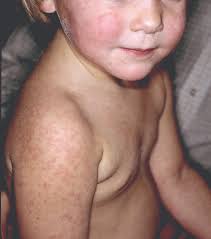 Petechiae are small, purpuric lesions up to 2mm across palpable purpura is purpura than can be felt, due to inflammation of the blood vessels (vasculitis) ecchymoses or bruises are larger extravasations of blood. A 5 Year Old With Rash On Extremities And Trunk