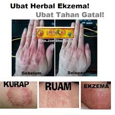 Bahan yang satu ini lebih sering. Ubat Gatal Herba Mujarab Ubat Kurap Ubat Ekzema Eczema Sensitive Kulit è—è¯çš®å® Shopee Malaysia