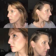 My friend's face is not symmetrical.The right side is much thicker than the  left.Left side seems thinner.Any SW/no/SP for this?