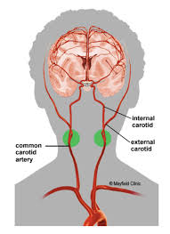 Location carotid arteries in neck. Carotid Artery Stenosis Hope For Hearts Australia