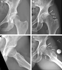 Image result for XRay Changes in Rheumatic Conditions