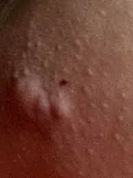 2) oil buildup and skin impurities: Crazy Cyst On My Upper Inner Thigh It Popped And A Tooooon Of Blood And Pus Came Out I M Worried About The Way It Looks The Raised Pores And The Proximity To