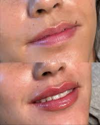 Meet your injector ✨💉 Katie Estes, RN, is the owner of our boutique  medspa, located downtown Monterey. With a background in plastic surgery and  dermatology, as well as a true eye for