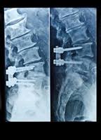 Was Ist Spondylose Ursachen Symptome Behandlung Krank De