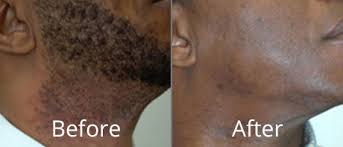 After the first brazilian laser hair removal session, most girls face intensive hair loss. Laser Hair Removal Before After Photos Cny Cosmetic Reconstructive Surgery Syracuse Ny