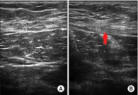 Documents similar to muscles of lower extremity, abdomen, skull. Ultrasonography Of Lower Abdominal Muscle A Left Side Normal B Download Scientific Diagram