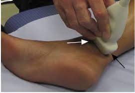 Tarsal Tunnel Syndrome Physiopedia