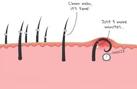 This basically means that the hair grows in all directions rather than just one. Removal Of Ingrown Hair Cysts Orlando Dermatology Center