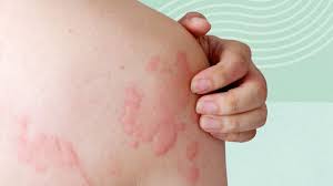 Image result for sweat rash on back