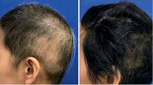 At my last appointment at the woodlands office with lauren, i had a couple of more questions about the process and she really took the time to explain everything. Hair Restoration Texas Regional Clinic