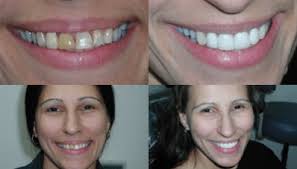 Smile Gallery: Transformations at Big Smile Dental Chicago