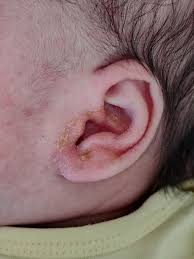 Image result for yellow scabs on the face in children