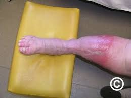 Image result for Lipodermatosclerosis