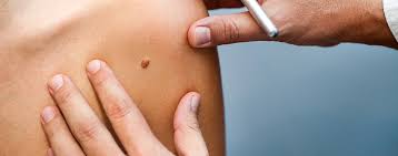 Atherome Grutzbeutel Dermatologie Am Neuen Wall