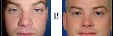 Maybe you would like to learn more about one of these? Big Nose Surgery Nose Refinement Surgery Dr Jose Barrera San Antonio Facial Plastic Surgeon Ent