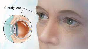 Are You Looking Cataract Surgery Doctor Chicago Ayurvedic Treatment Cataract Cataracts Remedies