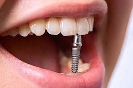 Сколько служат зубные импланты - Стоматология «Эксперт»