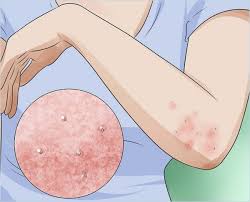 Image result for scabies human bites