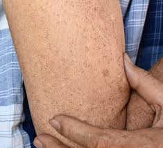 Image result for Melasma