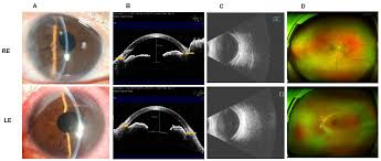 Effect of Combined Surgery in Patients with Complex Nanophthalmos