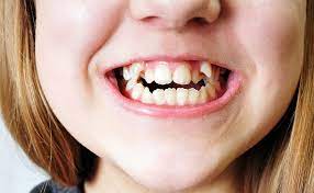 Aligning teeth is a complicated process that requires specialized tools and years of education. Free Dental Braces Can My Child Get Them Ridgway Dental Wimbledon Ridgway Dental Wimbledon