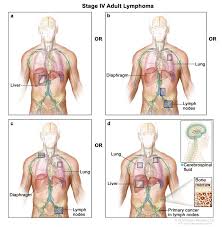 What if you had cancer, or were previously treated for a tumor? Lymphoma Cdc