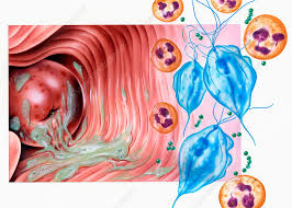 Image result for Vaginitis