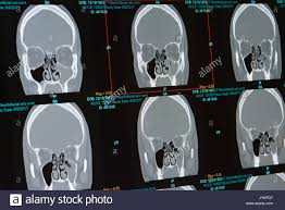 To read a ct scan, start by noting the shades of white, gray, and black since dense tissues like bone will be in the white areas, air and fat show as dark gray or black, and soft tissues and fluids will read. Ct Scan Der Mannlichen Mit Nasennebenhohlenentzundung Sinusitis Befullung Der Linken Kieferhohle Deckt Auch Abgewichen Septum Stockfotografie Alamy