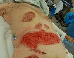 Early debridement and/or eschar removal is regarded as a significant step in the treatment of deep partial and full thickness burns. Cureus The Use Of V A C Veraflo Cleanse Choice In The Burn Population